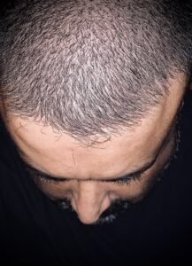A close view of thinning hair at the crown of a man's head, representing male pattern hair loss.